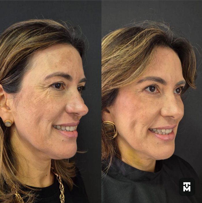 Resultado de harmonização facial, antes e depois, em perfil — ampliar imagem