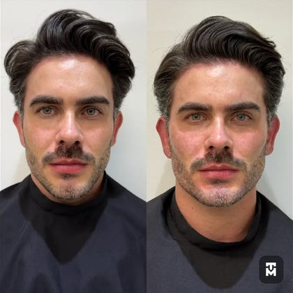 Resultado de procedimento facial masculino, antes e depois — ampliar imagem