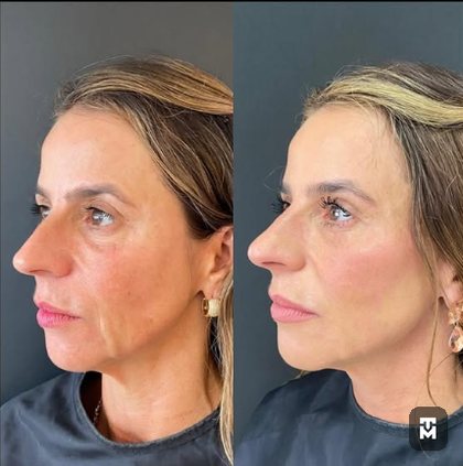 Resultado de harmonização facial, antes e depois, em perfil — ampliar imagem