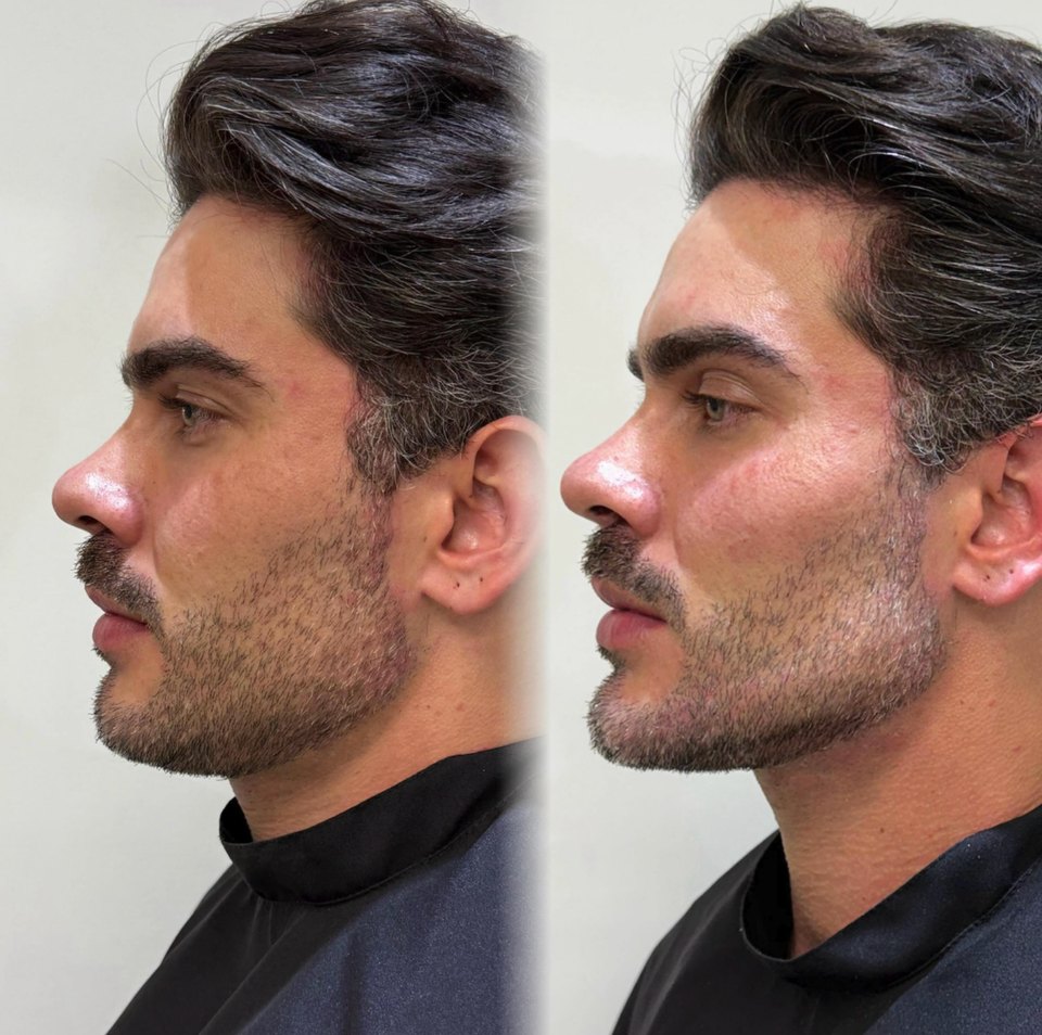 Comparativo autorizado de resultado estético facial, imagem 1 de 13