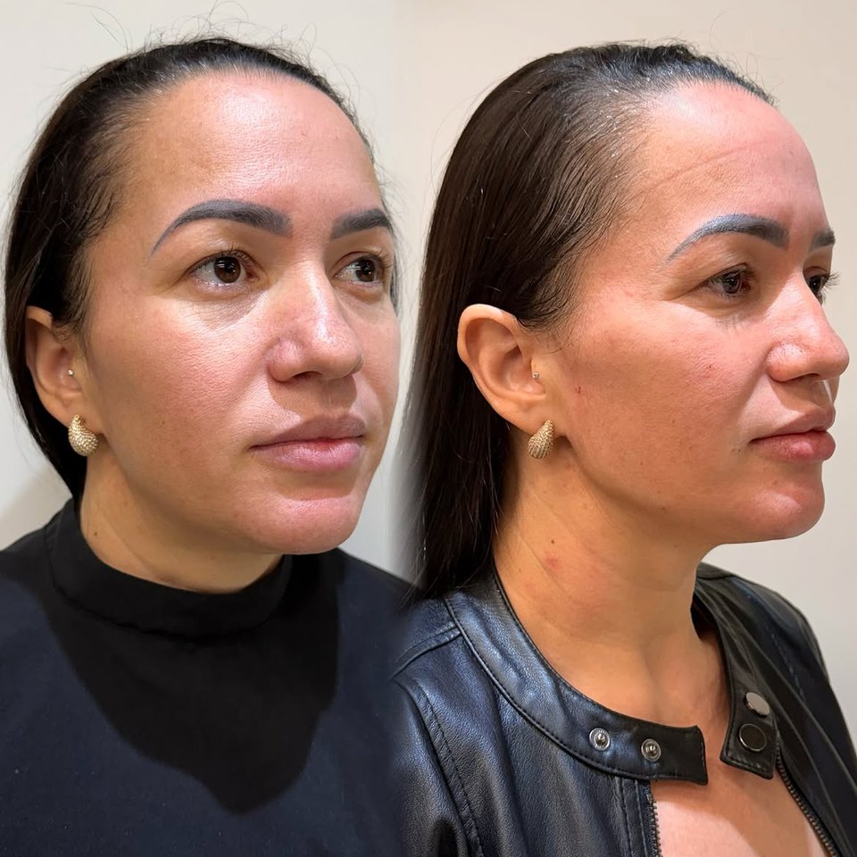 Comparativo autorizado de resultado estético facial, imagem 2 de 13