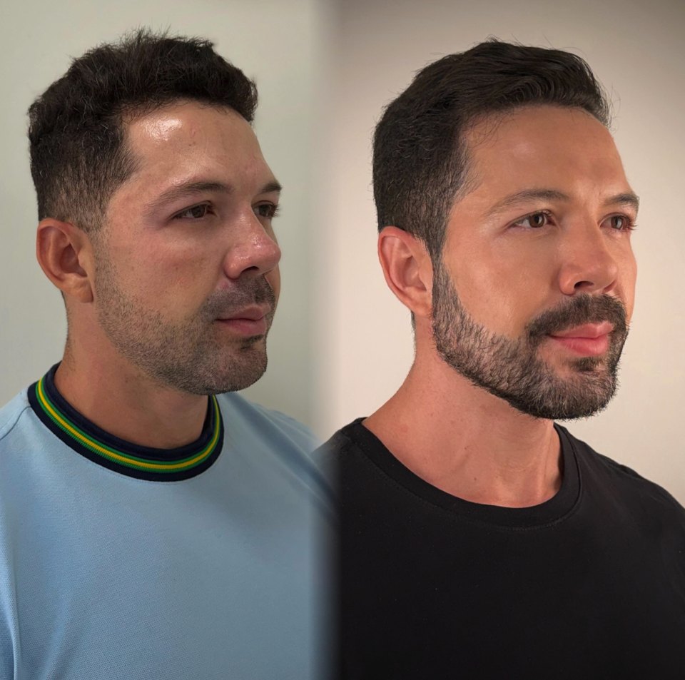 Comparativo autorizado de resultado estético facial, imagem 3 de 13