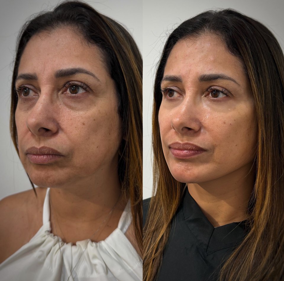 Comparativo autorizado de resultado estético facial, imagem 4 de 13