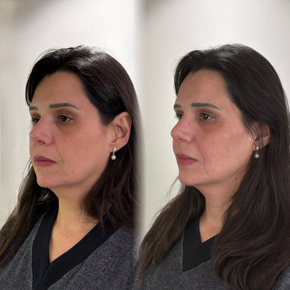 Comparativo autorizado de resultado estético facial, imagem 6 de 13